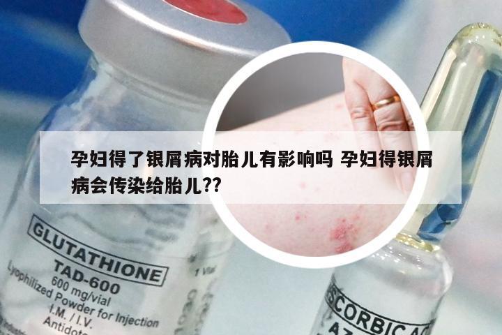 孕妇得了银屑病对胎儿有影响吗 孕妇得银屑病会传染给胎儿??