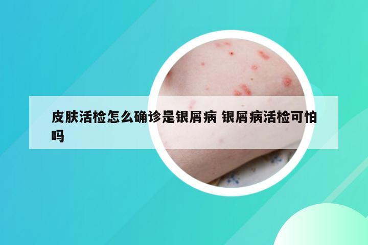 皮肤活检怎么确诊是银屑病 银屑病活检可怕吗