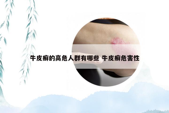 牛皮癣的高危人群有哪些 牛皮癣危害性