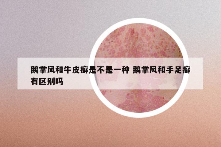 鹅掌风和牛皮癣是不是一种 鹅掌风和手足癣有区别吗