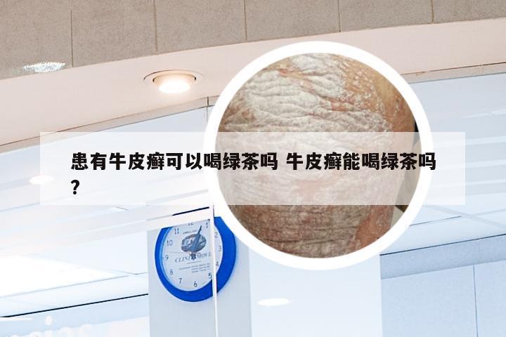 患有牛皮癣可以喝绿茶吗 牛皮癣能喝绿茶吗?