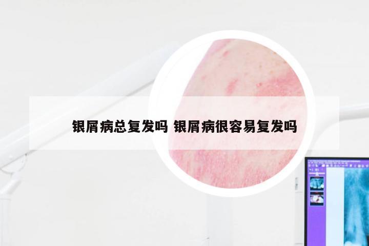 银屑病总复发吗 银屑病很容易复发吗