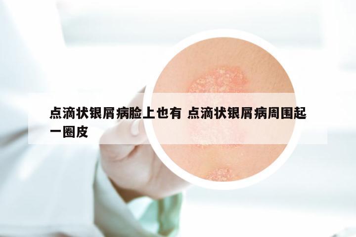 点滴状银屑病脸上也有 点滴状银屑病周围起一圈皮