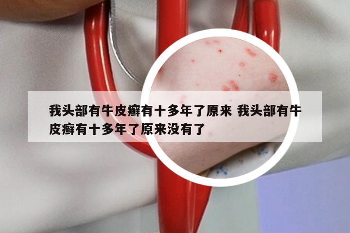 我头部有牛皮癣有十多年了原来 我头部有牛皮癣有十多年了原来没有了