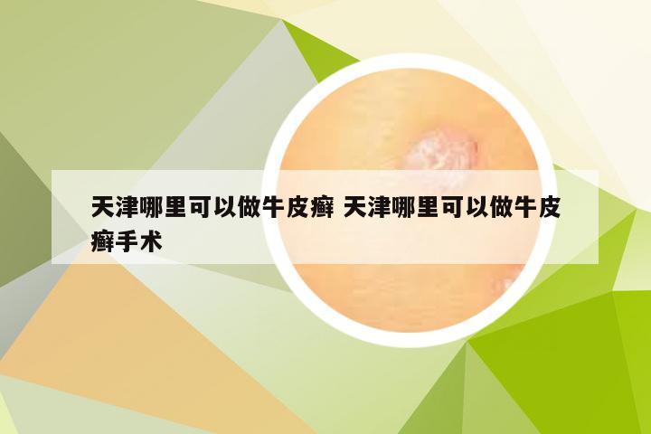 天津哪里可以做牛皮癣 天津哪里可以做牛皮癣手术