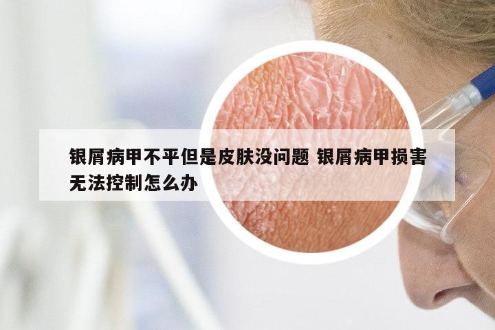 银屑病甲不平但是皮肤没问题 银屑病甲损害无法控制怎么办