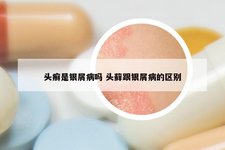 头癣是银屑病吗 头藓跟银屑病的区别