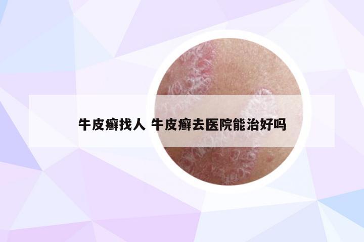 牛皮癣找人 牛皮癣去医院能治好吗
