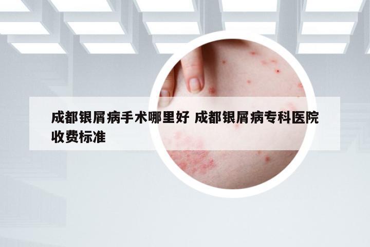 成都银屑病手术哪里好 成都银屑病专科医院收费标准