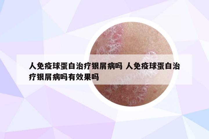 人免疫球蛋白治疗银屑病吗 人免疫球蛋白治疗银屑病吗有效果吗