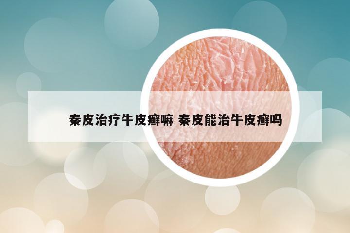 秦皮治疗牛皮癣嘛 秦皮能治牛皮癣吗