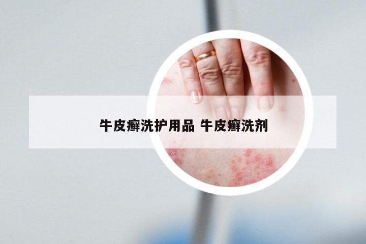 牛皮癣洗护用品 牛皮癣洗剂