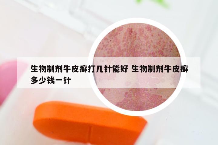 生物制剂牛皮癣打几针能好 生物制剂牛皮癣多少钱一针