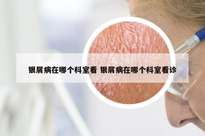 银屑病在哪个科室看 银屑病在哪个科室看诊