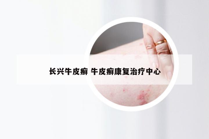 长兴牛皮癣 牛皮癣康复治疗中心