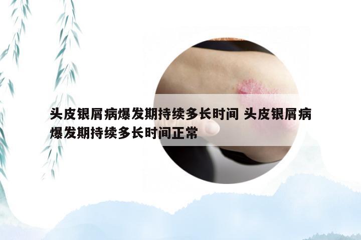 头皮银屑病爆发期持续多长时间 头皮银屑病爆发期持续多长时间正常