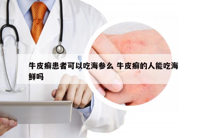 牛皮癣患者可以吃海参么 牛皮癣的人能吃海鲜吗