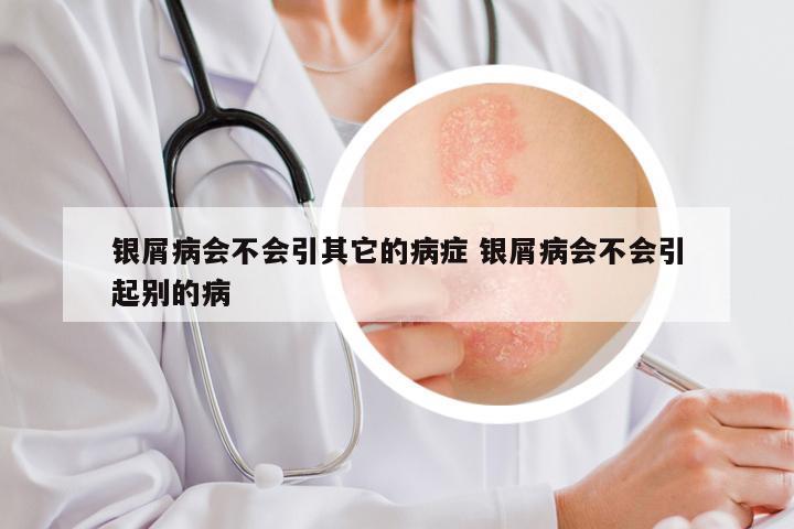 银屑病会不会引其它的病症 银屑病会不会引起别的病