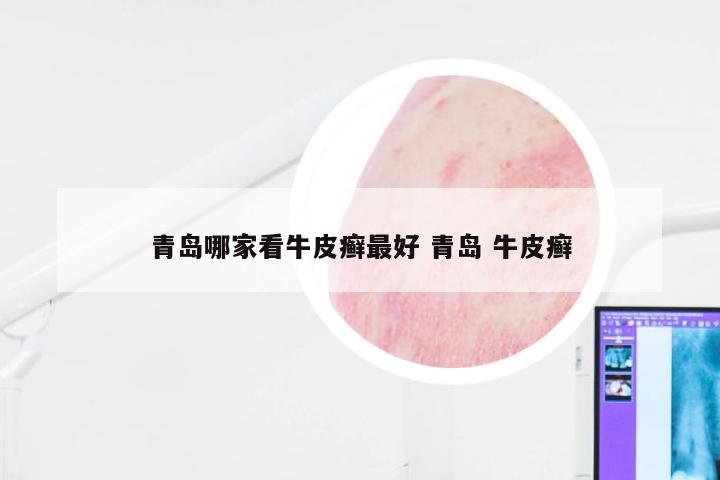 青岛哪家看牛皮癣最好 青岛 牛皮癣