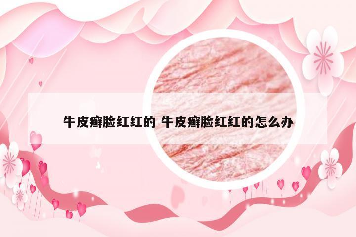 牛皮癣脸红红的 牛皮癣脸红红的怎么办