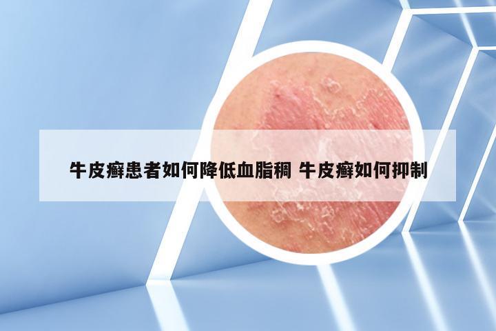 牛皮癣患者如何降低血脂稠 牛皮癣如何抑制