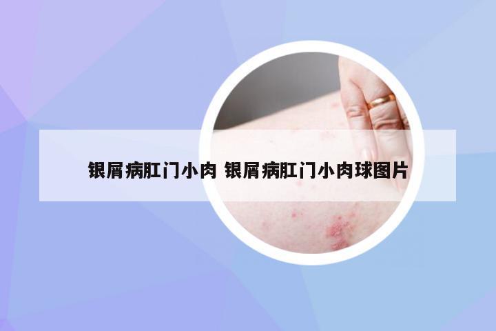 银屑病肛门小肉 银屑病肛门小肉球图片