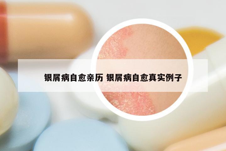 银屑病自愈亲历 银屑病自愈真实例子