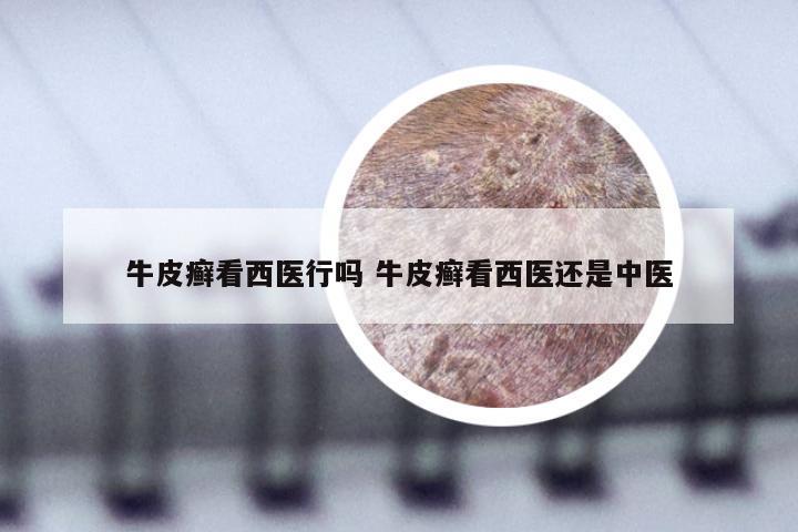 牛皮癣看西医行吗 牛皮癣看西医还是中医