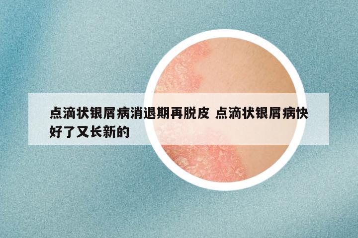 点滴状银屑病消退期再脱皮 点滴状银屑病快好了又长新的