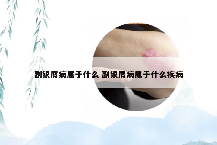 副银屑病属于什么 副银屑病属于什么疾病