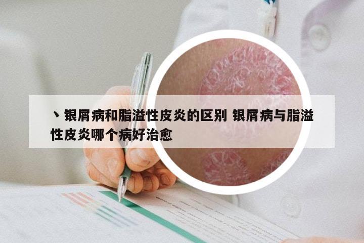 丶银屑病和脂溢性皮炎的区别 银屑病与脂溢性皮炎哪个病好治愈