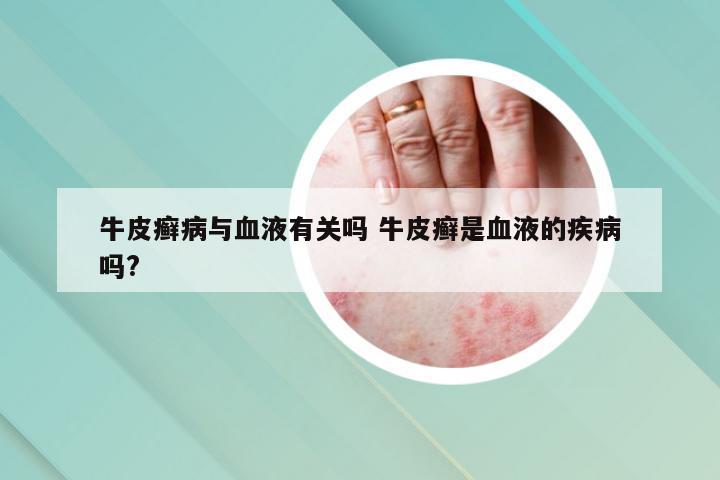 牛皮癣病与血液有关吗 牛皮癣是血液的疾病吗?