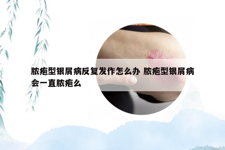 脓疱型银屑病反复发作怎么办 脓疱型银屑病会一直脓疱么