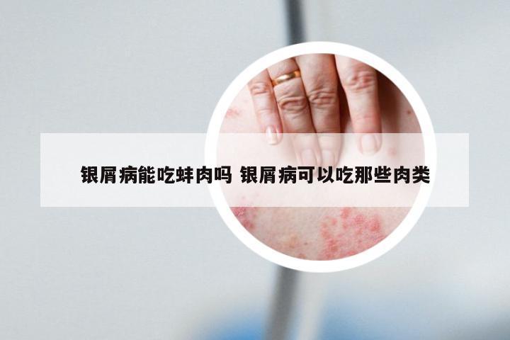 银屑病能吃蚌肉吗 银屑病可以吃那些肉类
