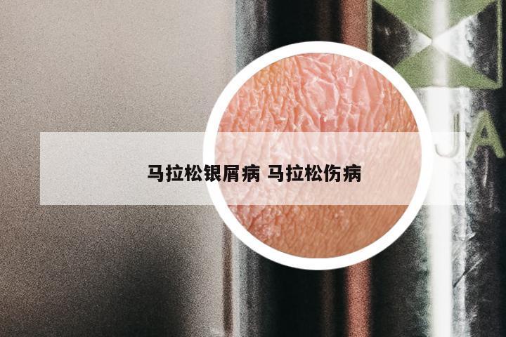 马拉松银屑病 马拉松伤病