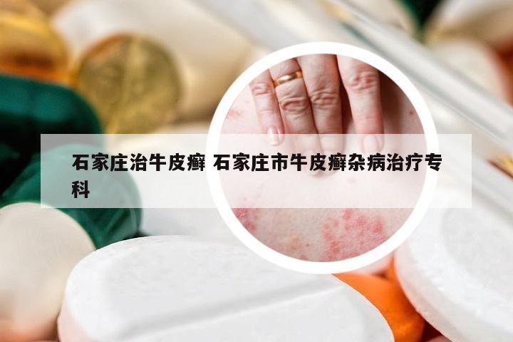 石家庄治牛皮癣 石家庄市牛皮癣杂病治疗专科
