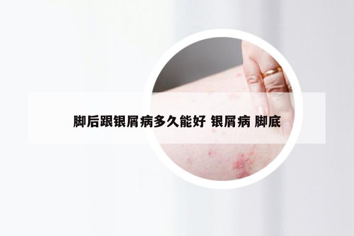 脚后跟银屑病多久能好 银屑病 脚底