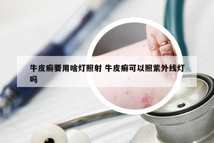 牛皮癣要用啥灯照射 牛皮癣可以照紫外线灯吗