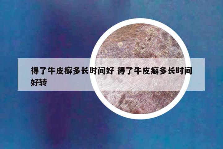 得了牛皮癣多长时间好 得了牛皮癣多长时间好转