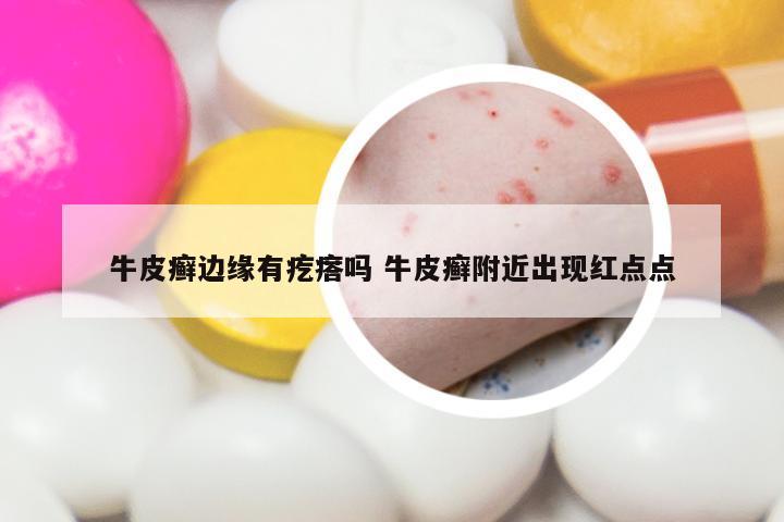 牛皮癣边缘有疙瘩吗 牛皮癣附近出现红点点