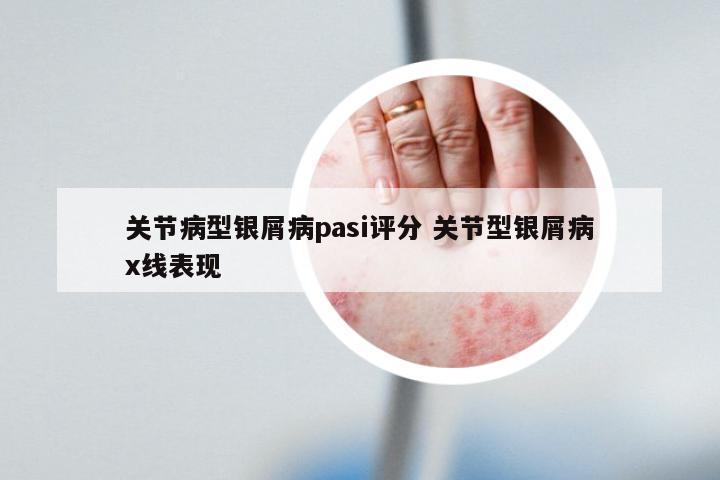 关节病型银屑病pasi评分 关节型银屑病x线表现