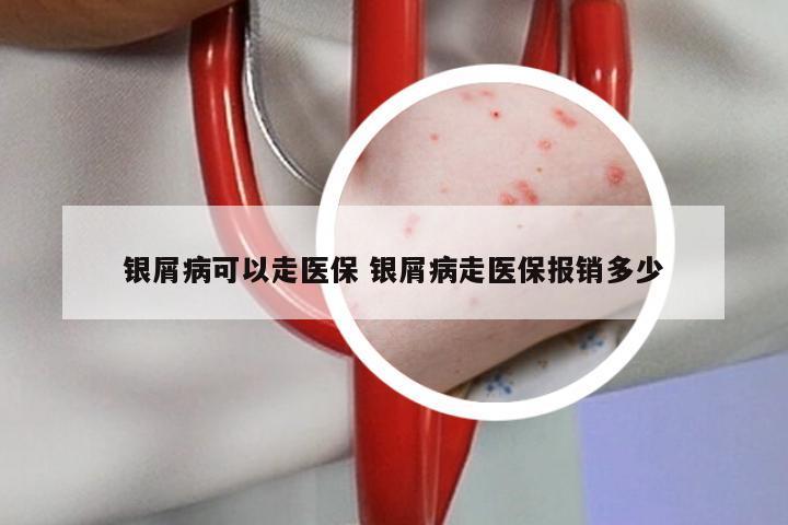 银屑病可以走医保 银屑病走医保报销多少