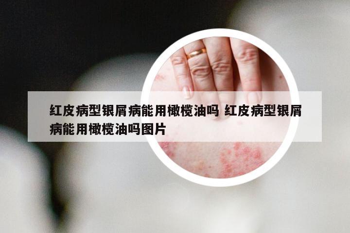 红皮病型银屑病能用橄榄油吗 红皮病型银屑病能用橄榄油吗图片