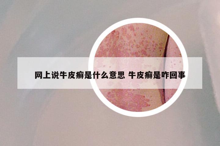 网上说牛皮癣是什么意思 牛皮癣是咋回事