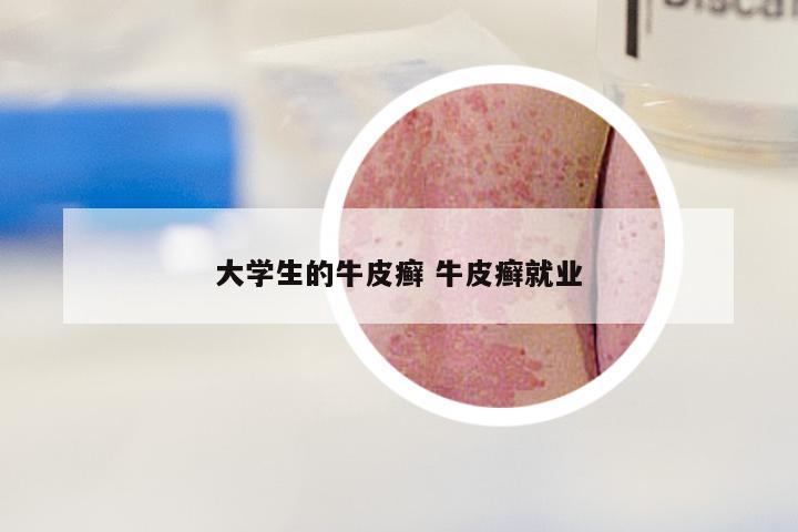 大学生的牛皮癣 牛皮癣就业