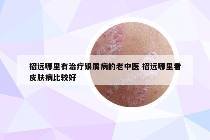 招远哪里有治疗银屑病的老中医 招远哪里看皮肤病比较好