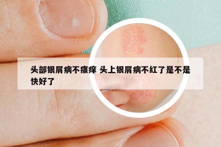 头部银屑病不瘙痒 头上银屑病不红了是不是快好了