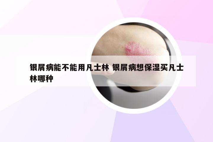 银屑病能不能用凡士林 银屑病想保湿买凡士林哪种