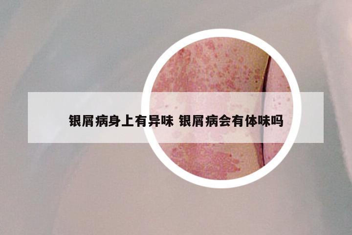 银屑病身上有异味 银屑病会有体味吗