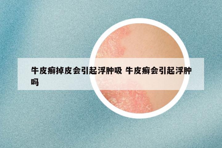 牛皮癣掉皮会引起浮肿吸 牛皮癣会引起浮肿吗